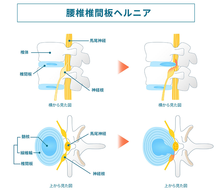 腰痛 神経痛 などに 腰痛・坐骨神経痛【足腰の痛み】の国家資格保持者による専門治療