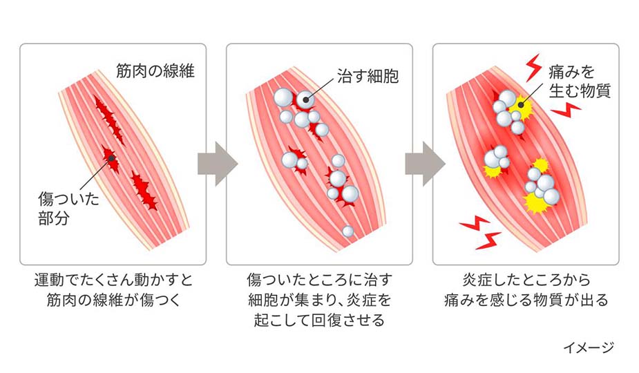 筋肉痛があるとき筋トレはOK？痛みの原因や対策も解説｜がんばるあなたに。疲れの情報局｜アリナミン